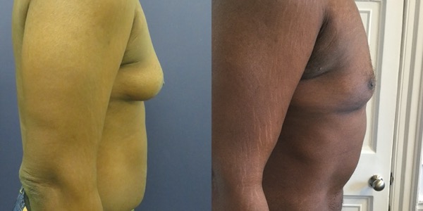 Gynaecomastia Before & After