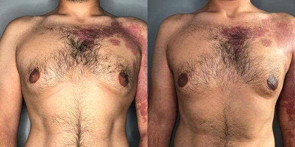 Gynaecomastia Before & After