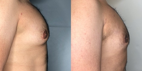 Gynaecomastia Before & After