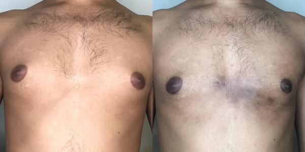 Gynaecomastia Before & After