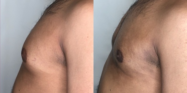 Gynaecomastia Before & After