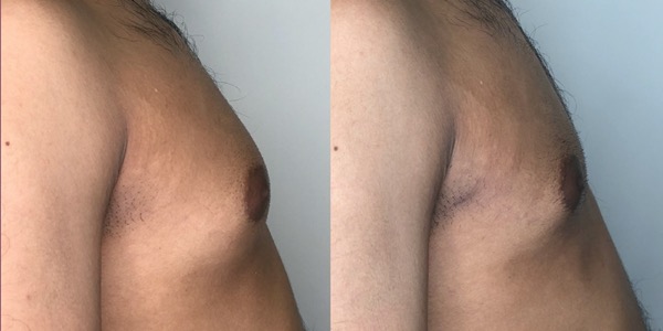 Gynaecomastia Before & After