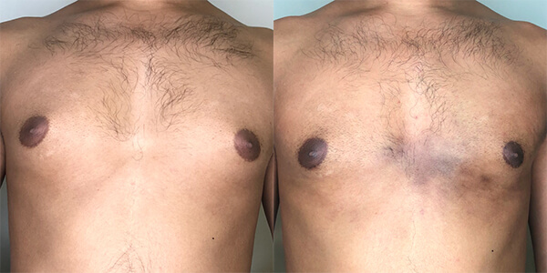 Gynaecomastia London Plastic Surgery