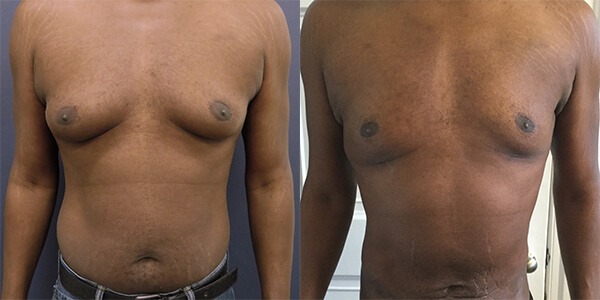 Gynaecomastia London Plastic Surgery