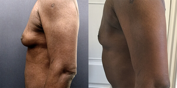 Male Chest Reduction - 001TPC-Side - The Private Clinic of Harley Street  London