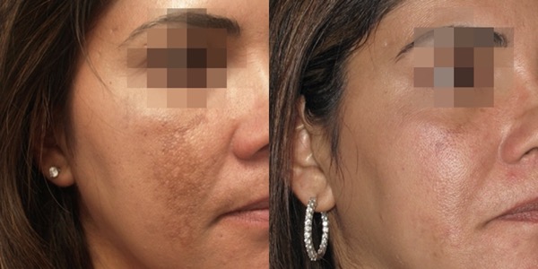 iPixel Laser Resurfacing Treatment Before & After