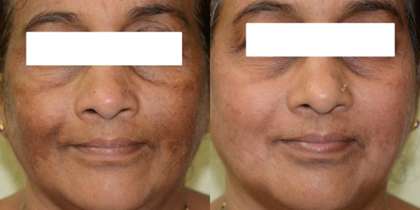 iPixel Laser Resurfacing Treatment Before & After