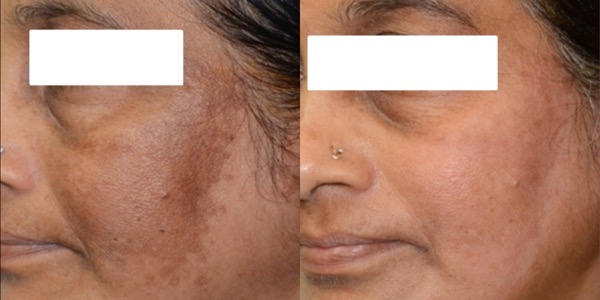 iPixel Laser Resurfacing Treatment Before & After