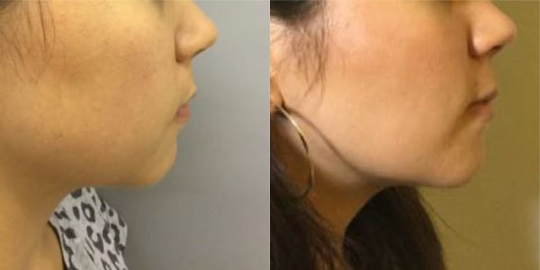 Buccal Fat Removal