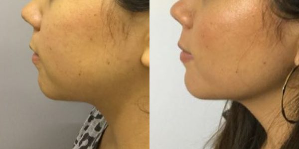 Buccal Fat Removal