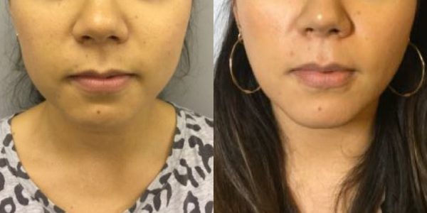 Buccal Fat Removal Before and After