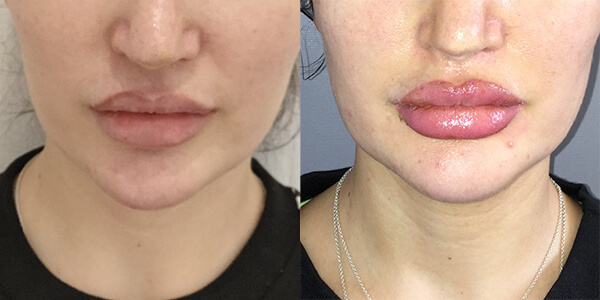 Jaw Reduction 111 Harley St.