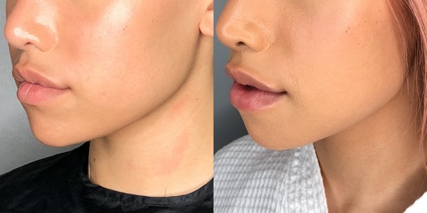 Jaw Reduction Before & After