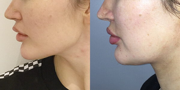 Jaw Reduction 111 Harley St.