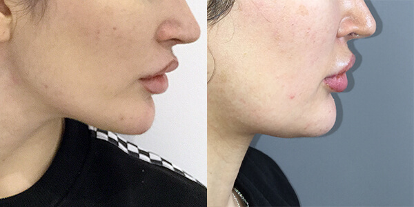 Jaw Reduction 111 Harley St.