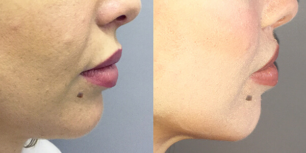 Lip Lift London Plastic Surgery