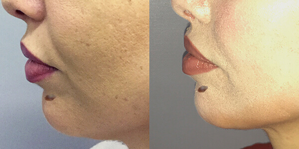 Lip Lift London Plastic Surgery