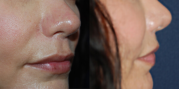 Lip Lift London Plastic Surgery