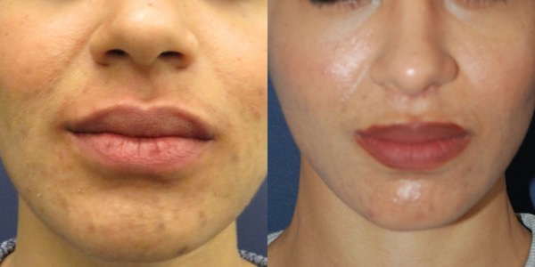 Lip Lift Before & After