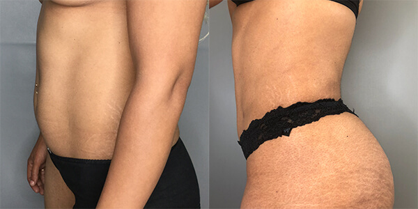 Liposuction 111 Harley St.