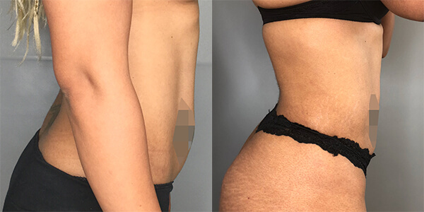 Liposuction 111 Harley St.