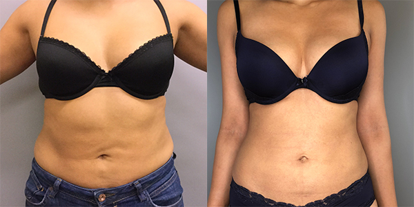 Liposuction 111 Harley St.