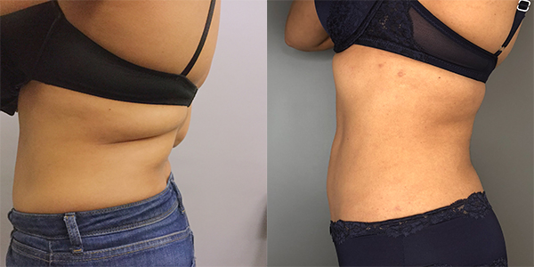 Liposuction 111 Harley St.