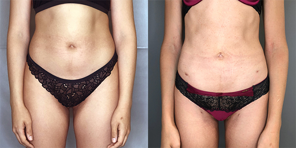 Liposuction 111 Harley St.