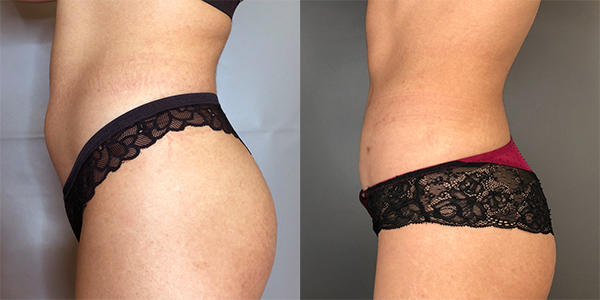 Liposuction 111 Harley St.