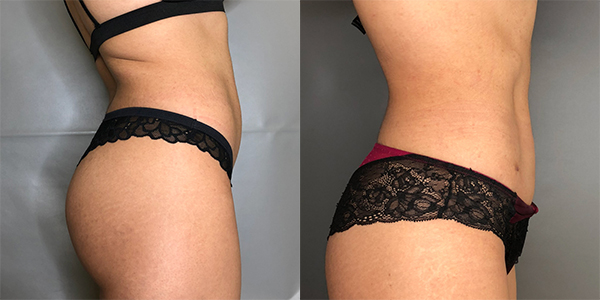 Liposuction 111 Harley St.