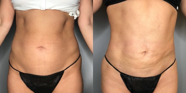 Liposuction Before & After