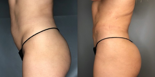 Liposuction Before & After