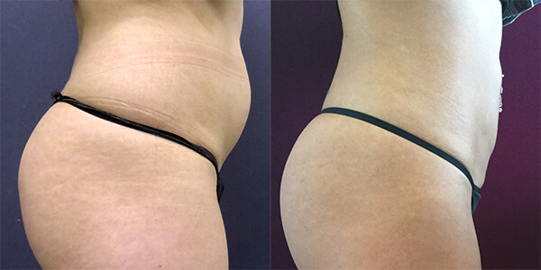 Liposuction 111 Harley St.