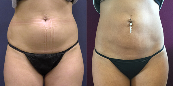 Liposuction 111 Harley St.