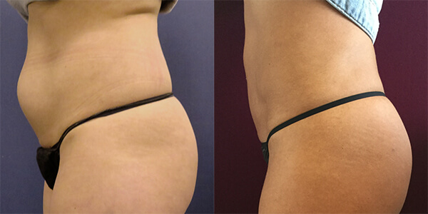 Liposuction 111 Harley St.