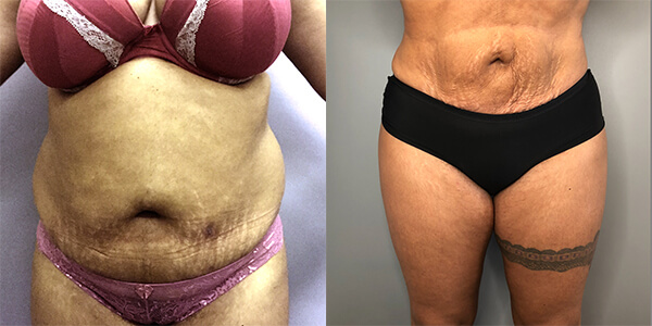 Liposuction 111 Harley St.