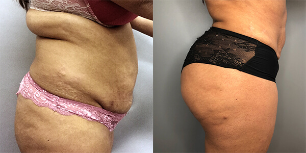 Liposuction 111 Harley St.