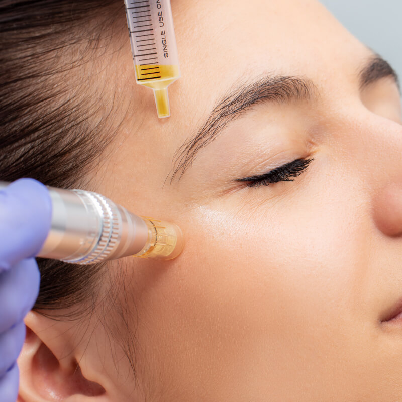 Mesotherapy