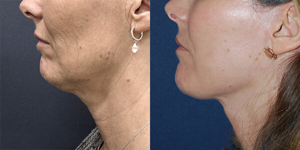 Neck Lift London Plastic Surgery