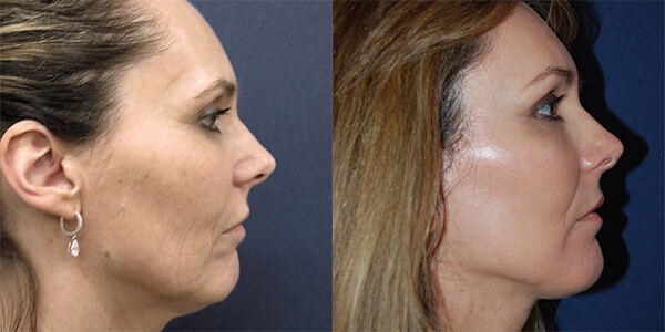 Neck Lift London Plastic Surgery