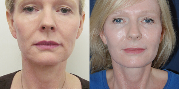 Neck Lift London Plastic Surgery