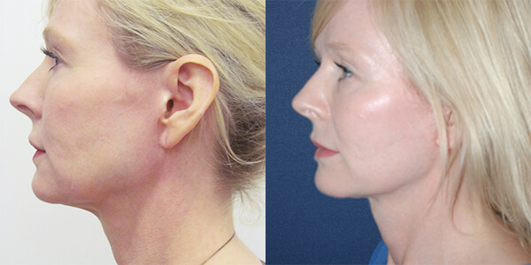 Neck Lift London Plastic Surgery