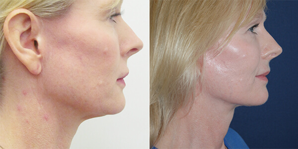 Neck Lift London Plastic Surgery