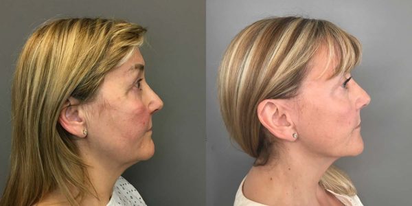 A Deep Plane Facelift Before and After Photo