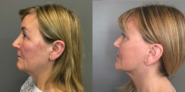 A Deep Plane Facelift Before and After Photo