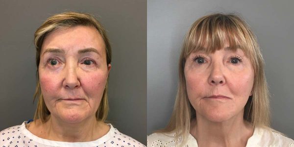 A Deep Plane Facelift Before and After Photo