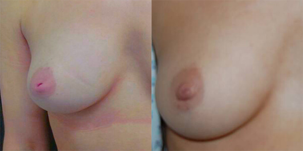 Nipple Correction London Plastic Surgery