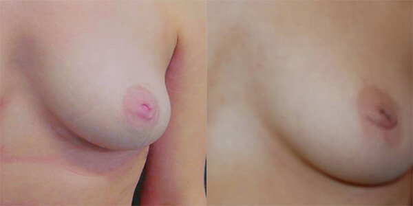 Nipple Correction London Plastic Surgery