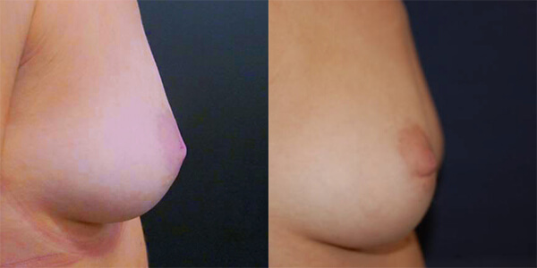 Nipple Correction London Plastic Surgery