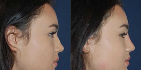Non-Surgical Rhinoplasty Before & After